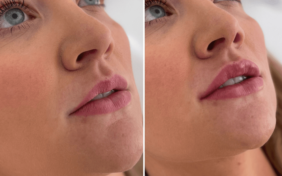 before and after lip filler treatment at trikwan aesthetics london