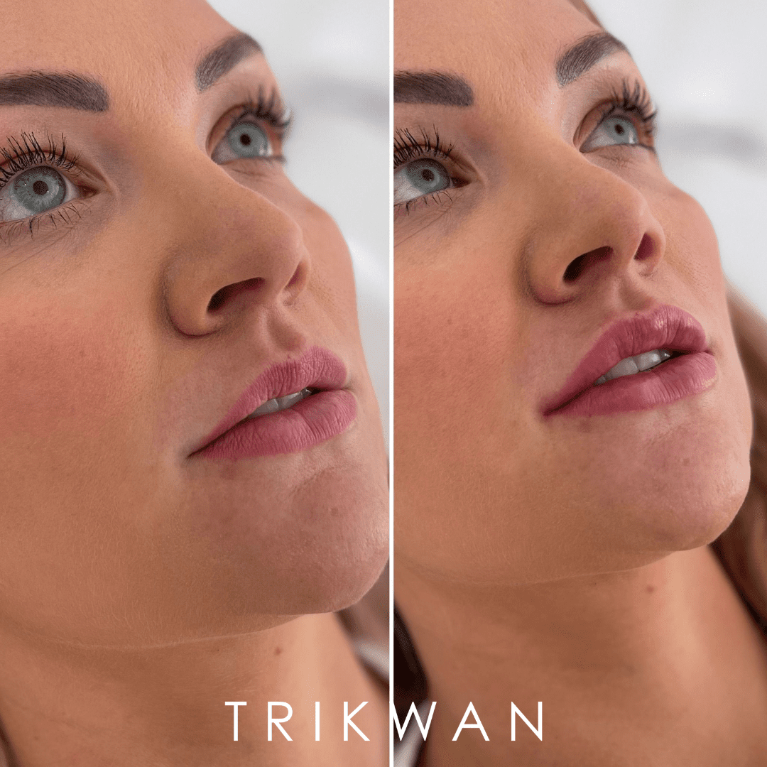 Lip Filler Myths, Debunked: The Truth About Natural Lip Enhancement