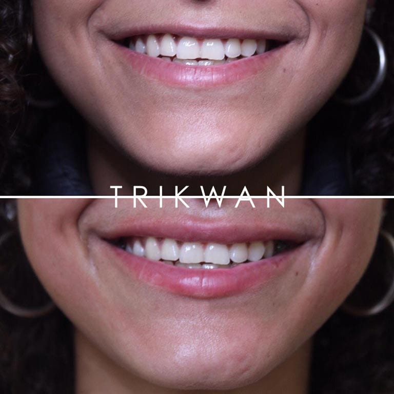 Filler Removal TRIKWAN Aesthetics Filler Correction Marylebone