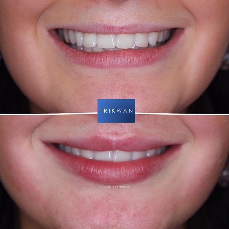 Filler Removal TRIKWAN Aesthetics Filler Correction Marylebone