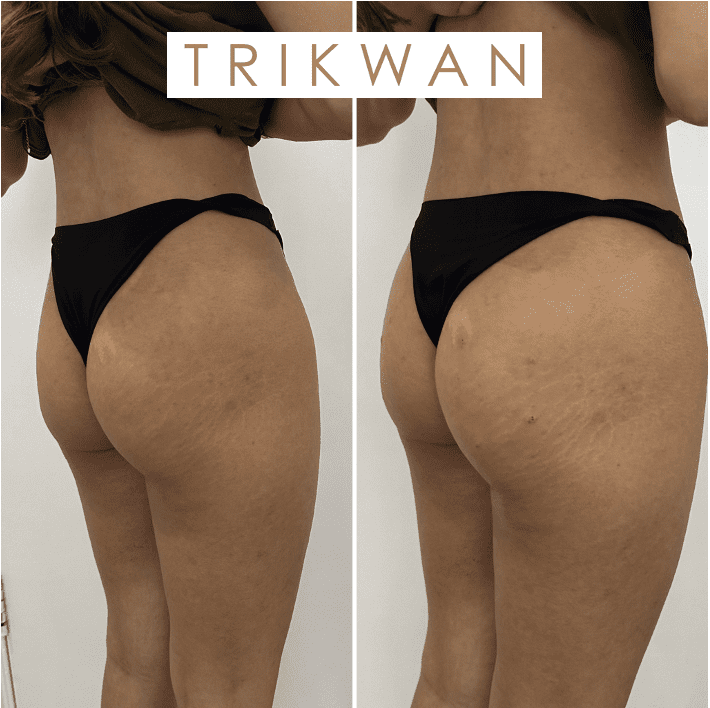 sculptra body before and after