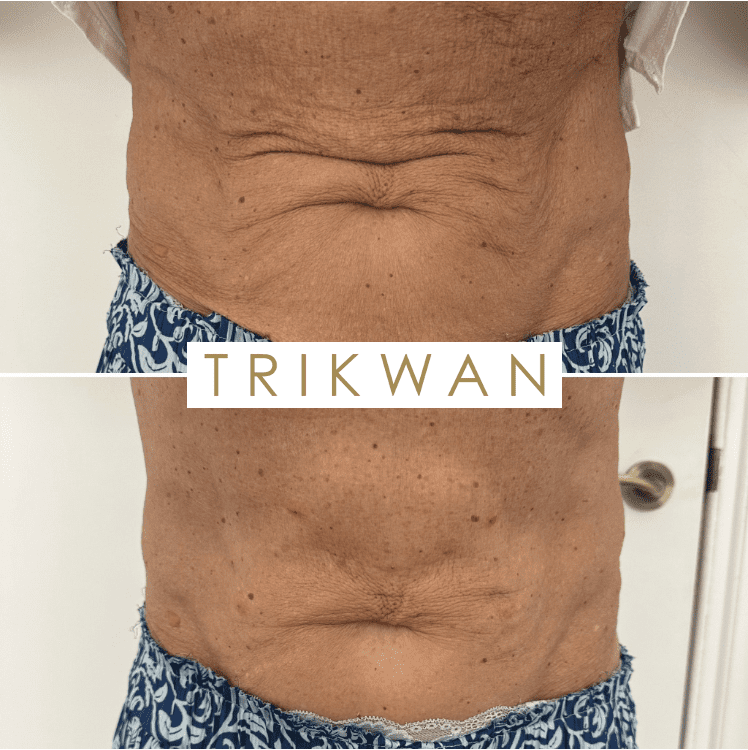 Sculptra Body london before and after