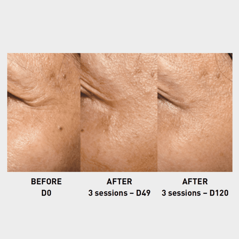 crows feet treatment