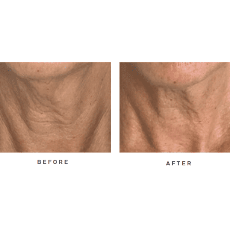 nctf before and after