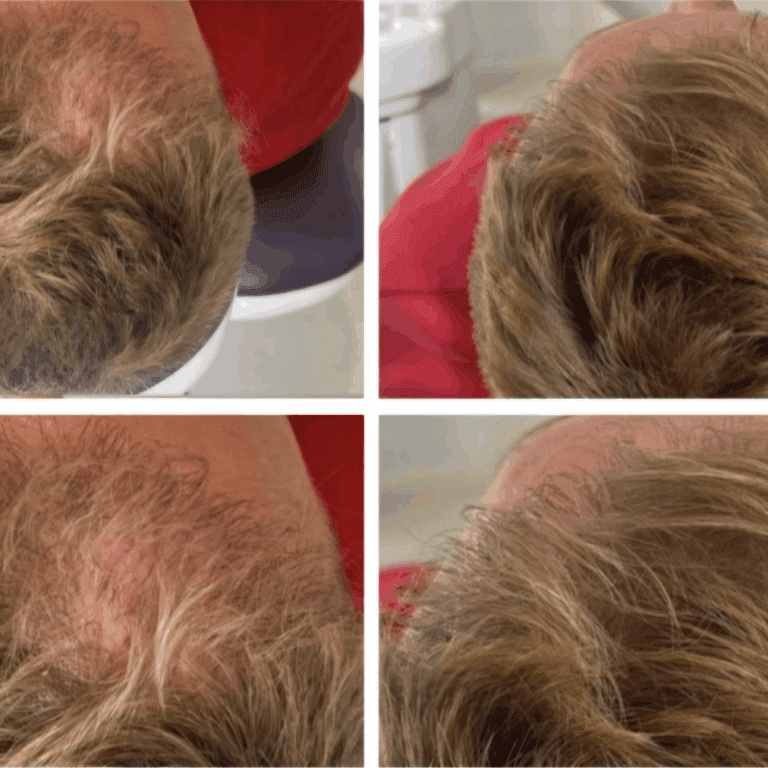 exosomes for hair loss