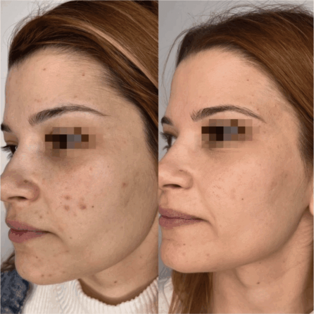 exosomes for acne