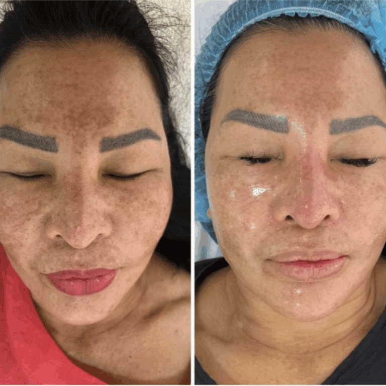 exosomes for pigmentation