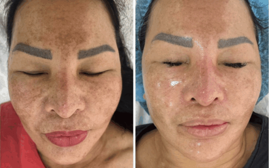 exosomes for pigmentation