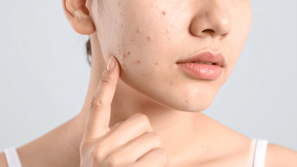 How Long Does the Tretinoin Purge Last? Timeline, Stages, and When It Improves