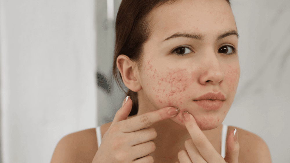 Tretinoin Purge vs Breakout: How to Tell the Difference and When to Seek Expert Advice