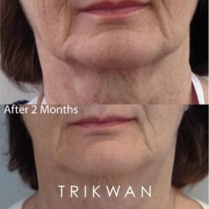 mature women close up photo of a before and after redensity 1 treatment