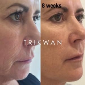 mature women close up photo of a before and after redensity 1 treatment