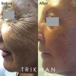 mature women close up photo of a before and after redensity 1 treatment